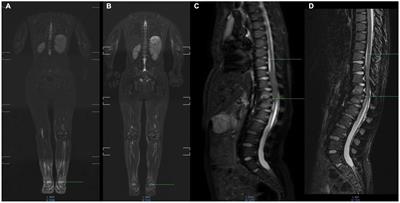 Evaluation of etanercept (a tumor necrosis factor alpha inhibitor) as an effective treatment for joint disease in mucopolysaccharidosis type I. A case report with whole-body magnetic resonance imaging